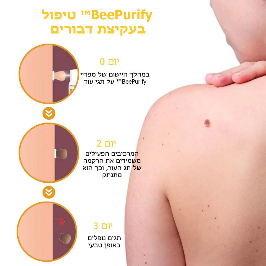 BeePurify™ | תרסיס טיפולי מתקדם לאבעבועות מארס דבורים