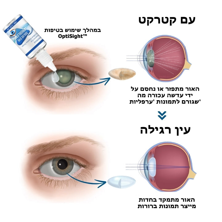 OptiSight™ | טיפות עיניים להפוך קוצר ראייה
