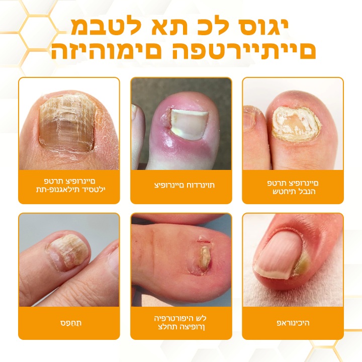 PureNails™ | קבל ציפורן בריאה יותר, חזקה יותר וללא פטריות תוך 7 ימים בלבד!