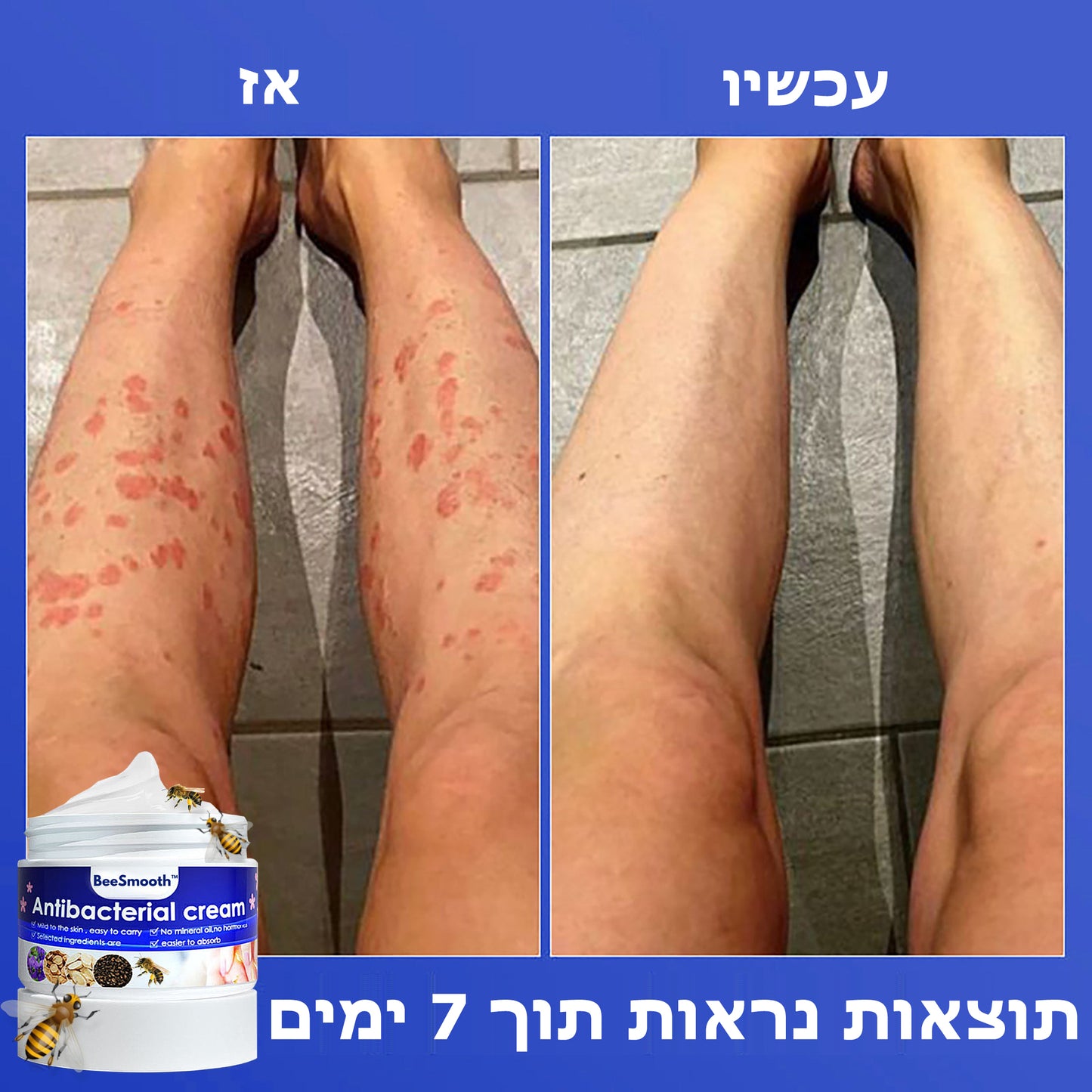 BeeSmooth™ | קרם נגד פסוריאזיס אנטיבקטריאלי עם רעל דבורים