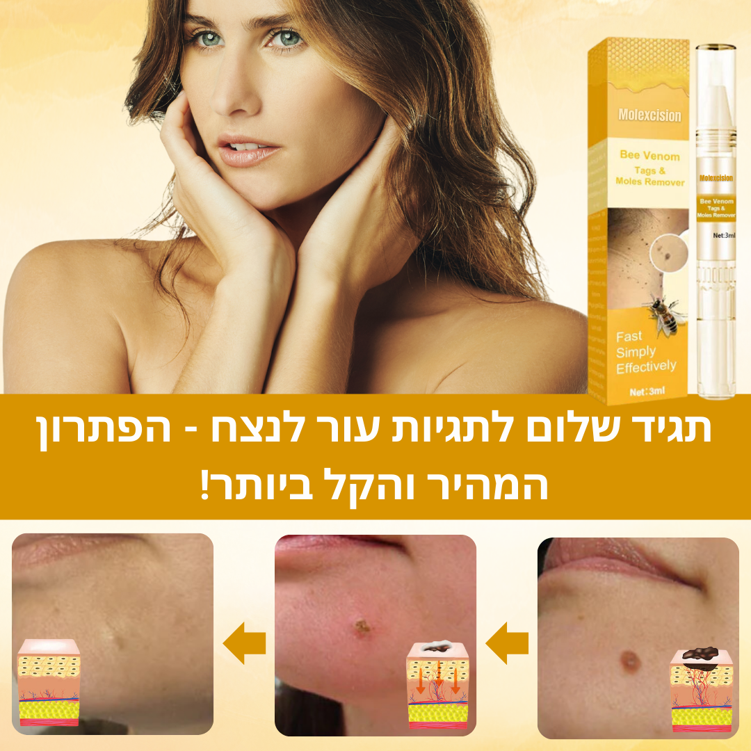 Molexcision™ | היפטר משומות ותגיות עור באופן מיידי