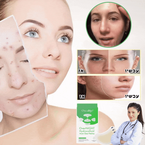AcneCure