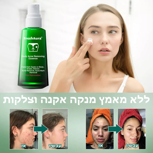 FreshAura™ | סרום להבהרת אקנה בגוף