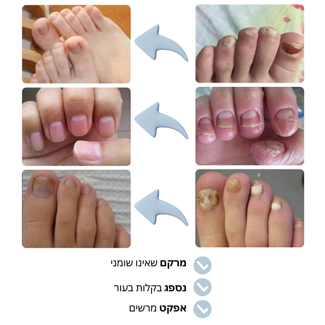 Dermasil™ | ג'ל פטרת ציפורניים  משמיד 99% מהחיידקים בפחות מדקה