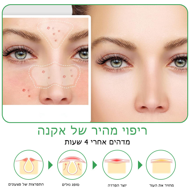 AcneCure™ | טלאים לטיפול באקנה הידרוקולואידיים ללילה