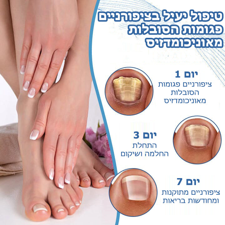 NailFame™ | נוזל לטיפול בפטרת ציפורניים