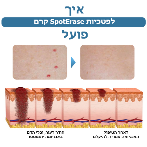SpotErase™ | קרם להסרת פטכיות