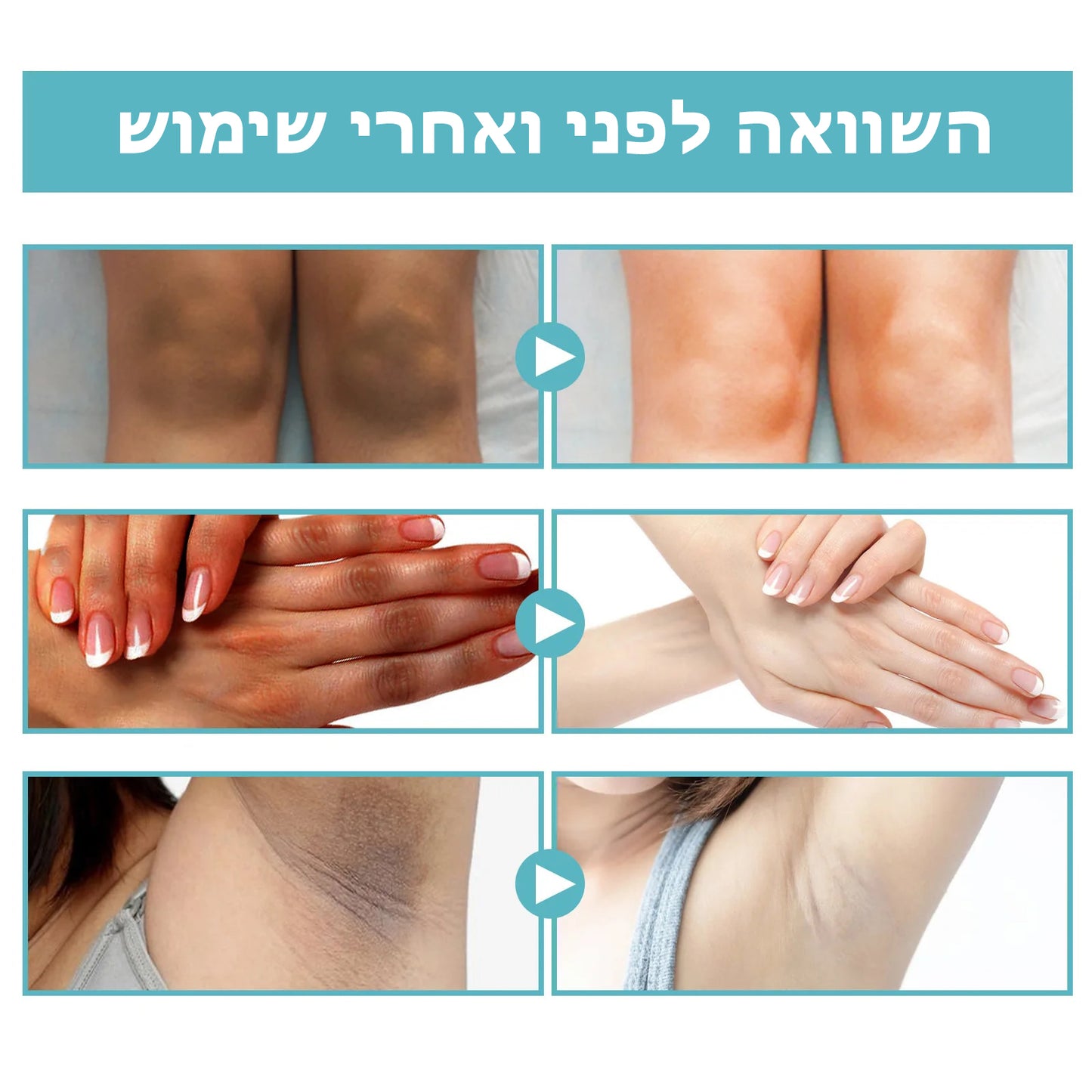 FadeShade™ | קרם טיפול בהיפרפיגמנטציה של אקנתוזיס ניגריקנס