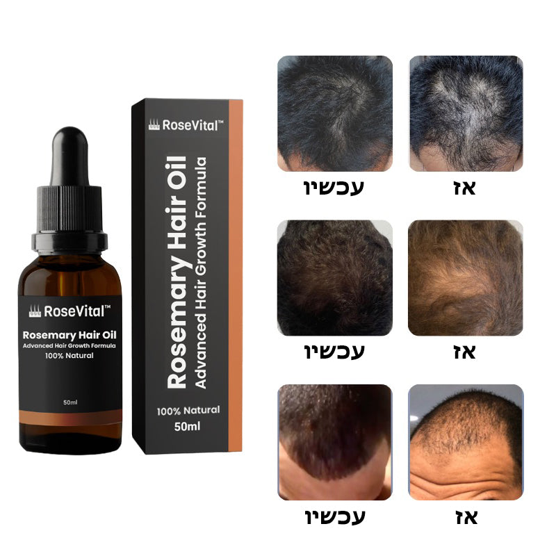 RoseVital™ | שמן רוזמרין לצמיחת שיער