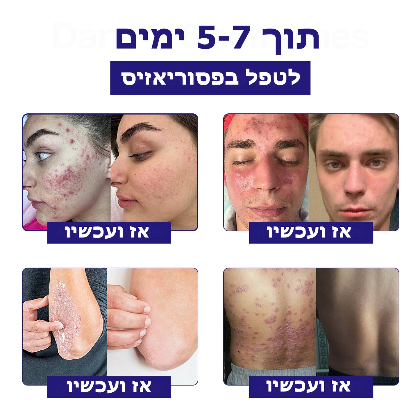 BeeSmoothie™ | קרם אנטיבקטריאלי לפסוריאזיס