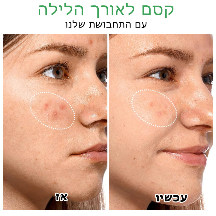 AcneCure™ | טלאים לטיפול באקנה הידרוקולואידיים ללילה