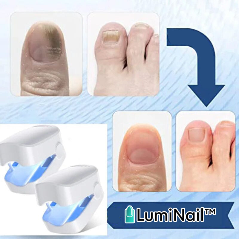 LumiNail™ | מכשיר תרפיה באור למחלות ציפורניים