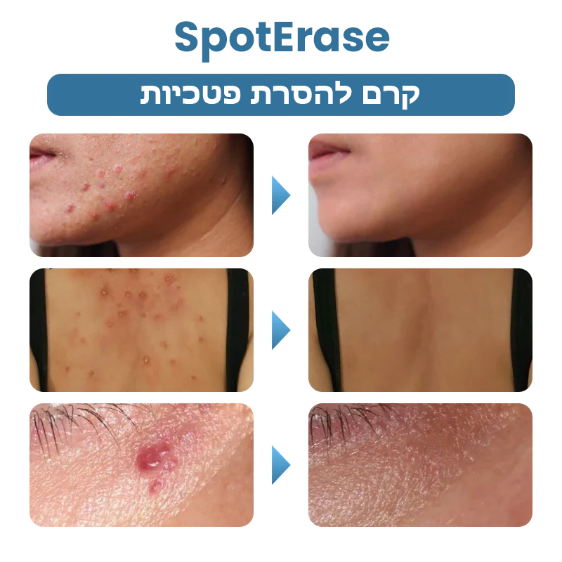 SpotErase™ | קרם להסרת פטכיות