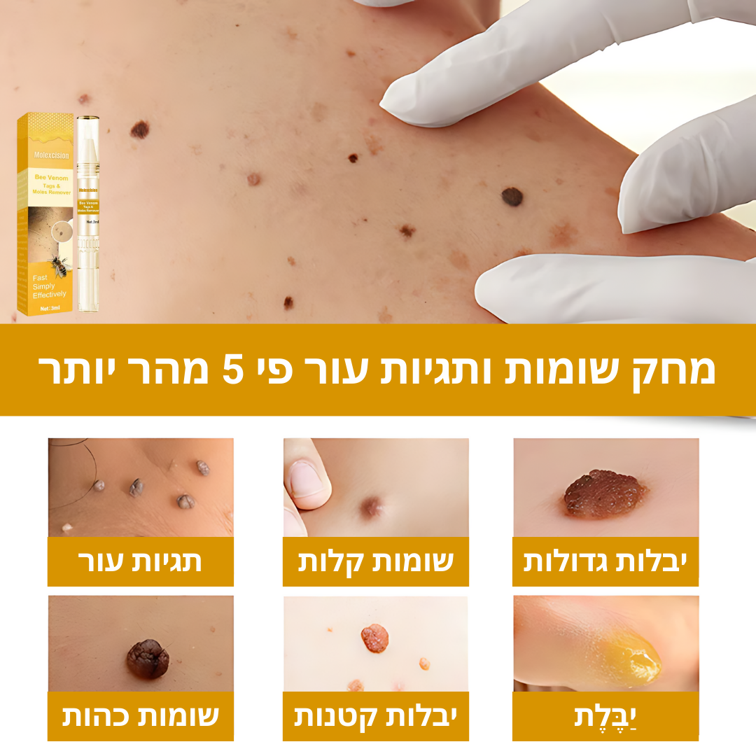 Molexcision™ | היפטר משומות ותגיות עור באופן מיידי
