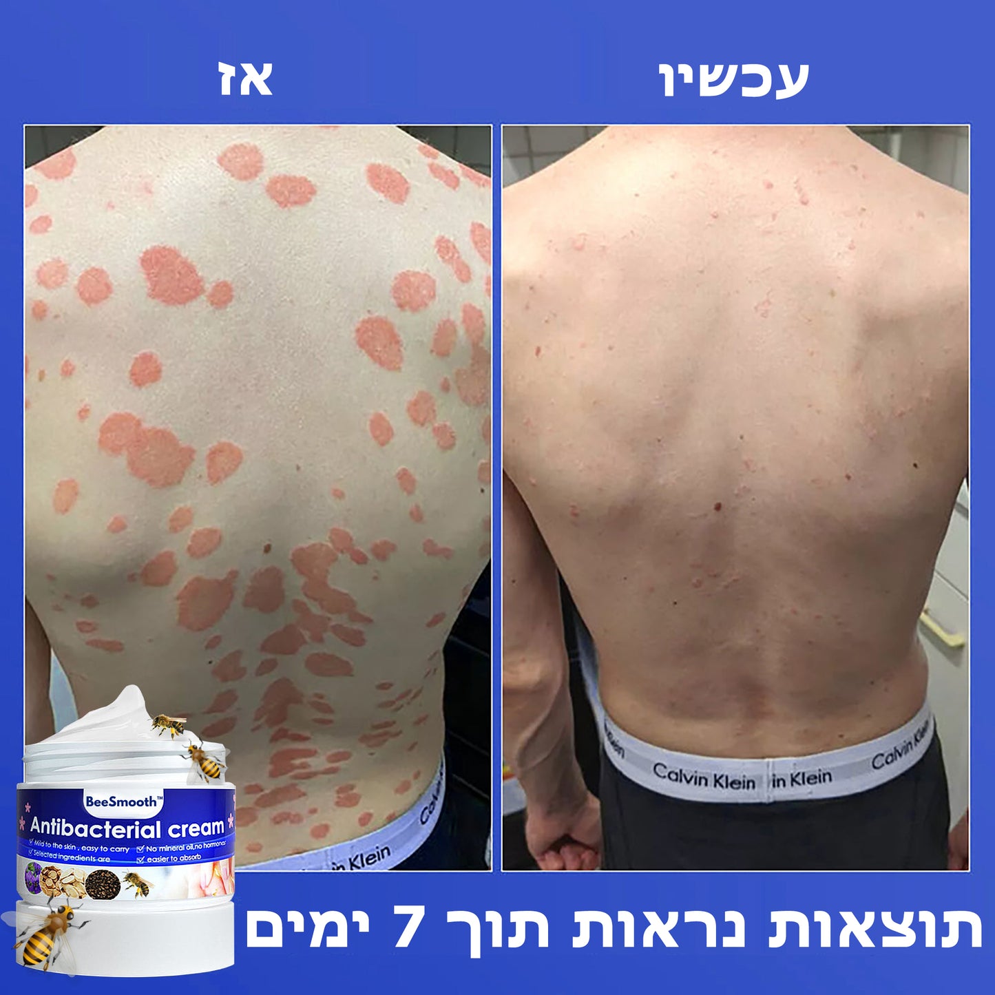 BeeSmoothie™ | קרם אנטיבקטריאלי לפסוריאזיס