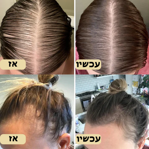 FolliGrow™ | שמן לגידול שיער טבעוני