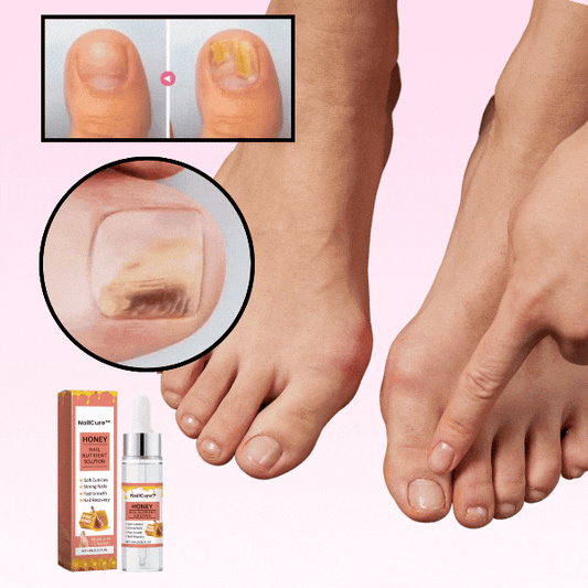 NailCure™ | חיסול 99% מפטרת ציפורניים וחדש צמיחה של ציפורניים בריאות תוך 14 ימים בלבד!