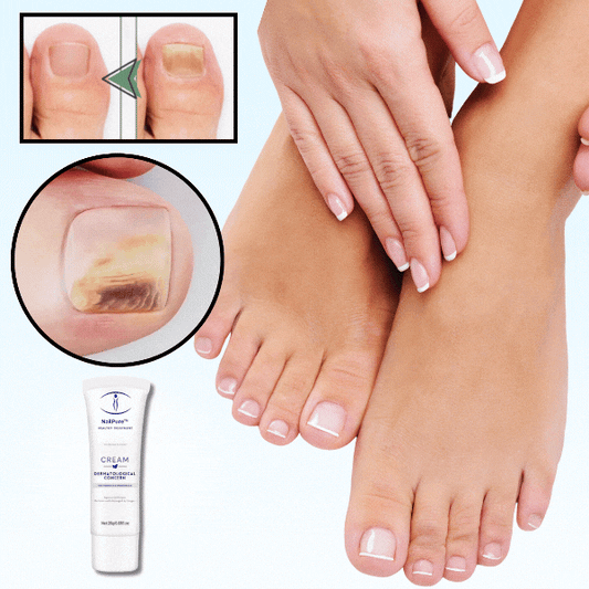 NailPure™ | הסירו את פטריית הציפורניים המטרידה תוך 5 ימים בלבד!