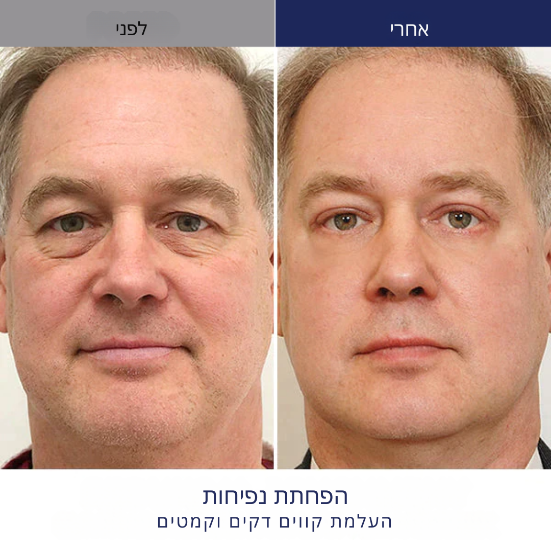 EyeRevive™ | מוחק עיגולים כהים ונפיחות ב-87% תוך יומיים בלבד!